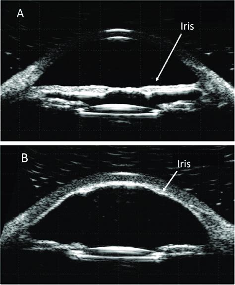 ubm ultrasound